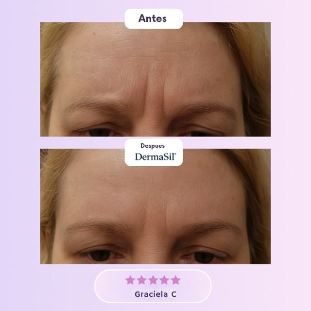 DermaSil® – Silicona Médica para Cicatrices y Líneas de Expresión