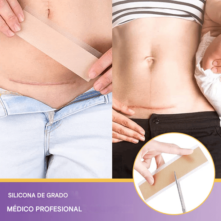 DermaSil® – Silicona Médica para Cicatrices y Líneas de Expresión